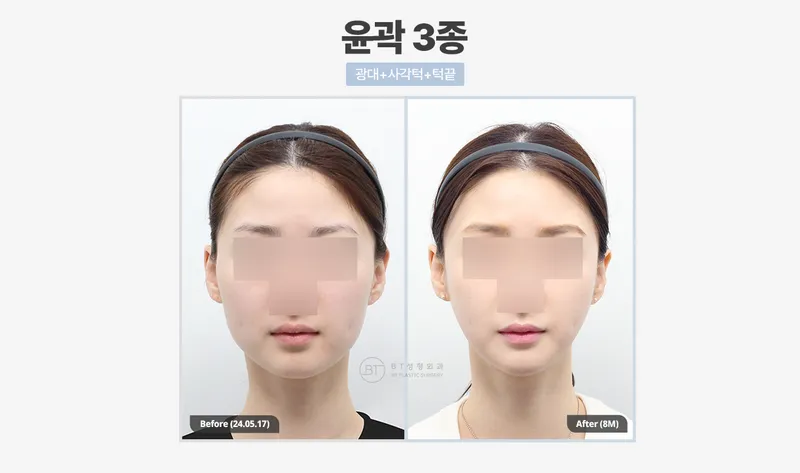 비티성형외과의원 강남