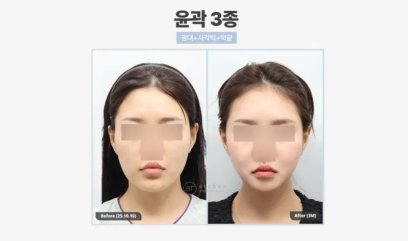 비티성형외과의원 강남