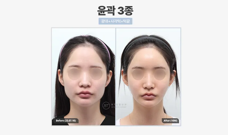 비티성형외과의원 강남