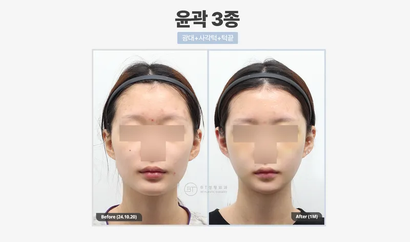 비티성형외과의원 강남