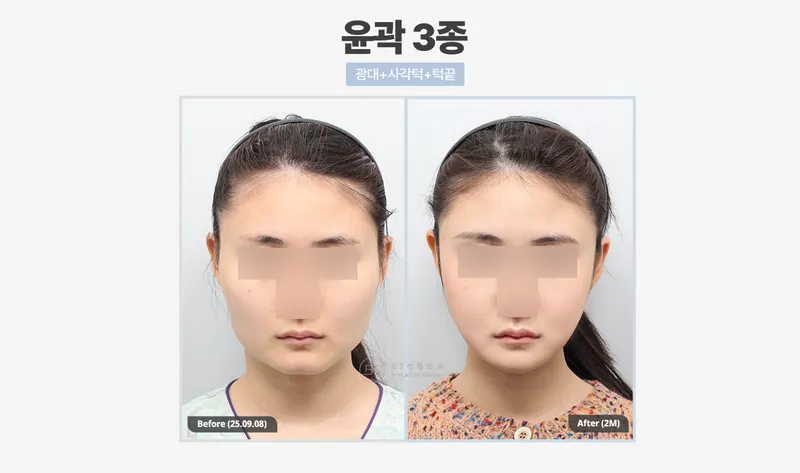 비티성형외과의원 강남
