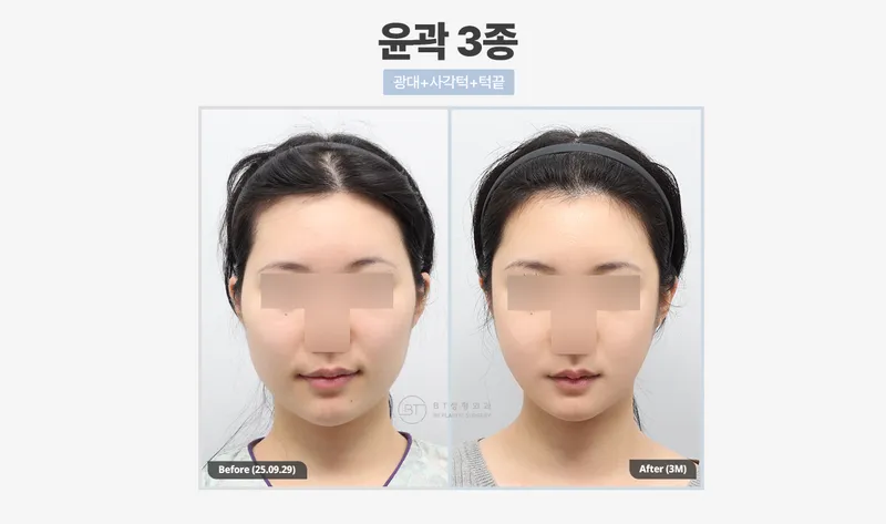 비티성형외과의원 강남