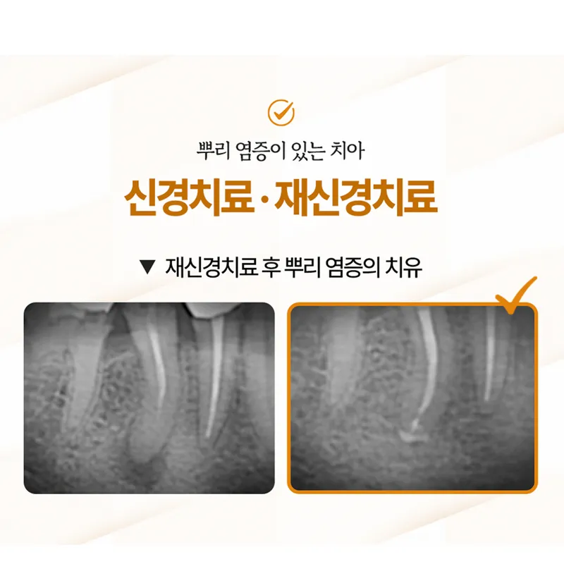 Self-Extraction Tooth Clinic Samsung Plant