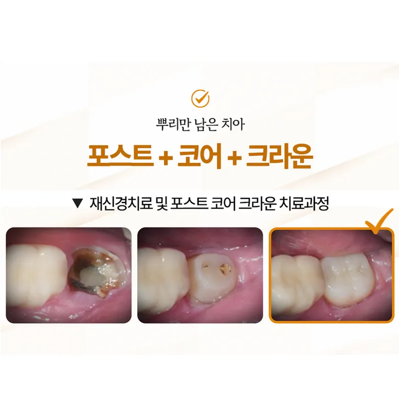 Self-Extraction Tooth Clinic Samsung Plant