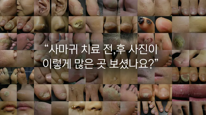 Kyunghee Pityriasis Clinic